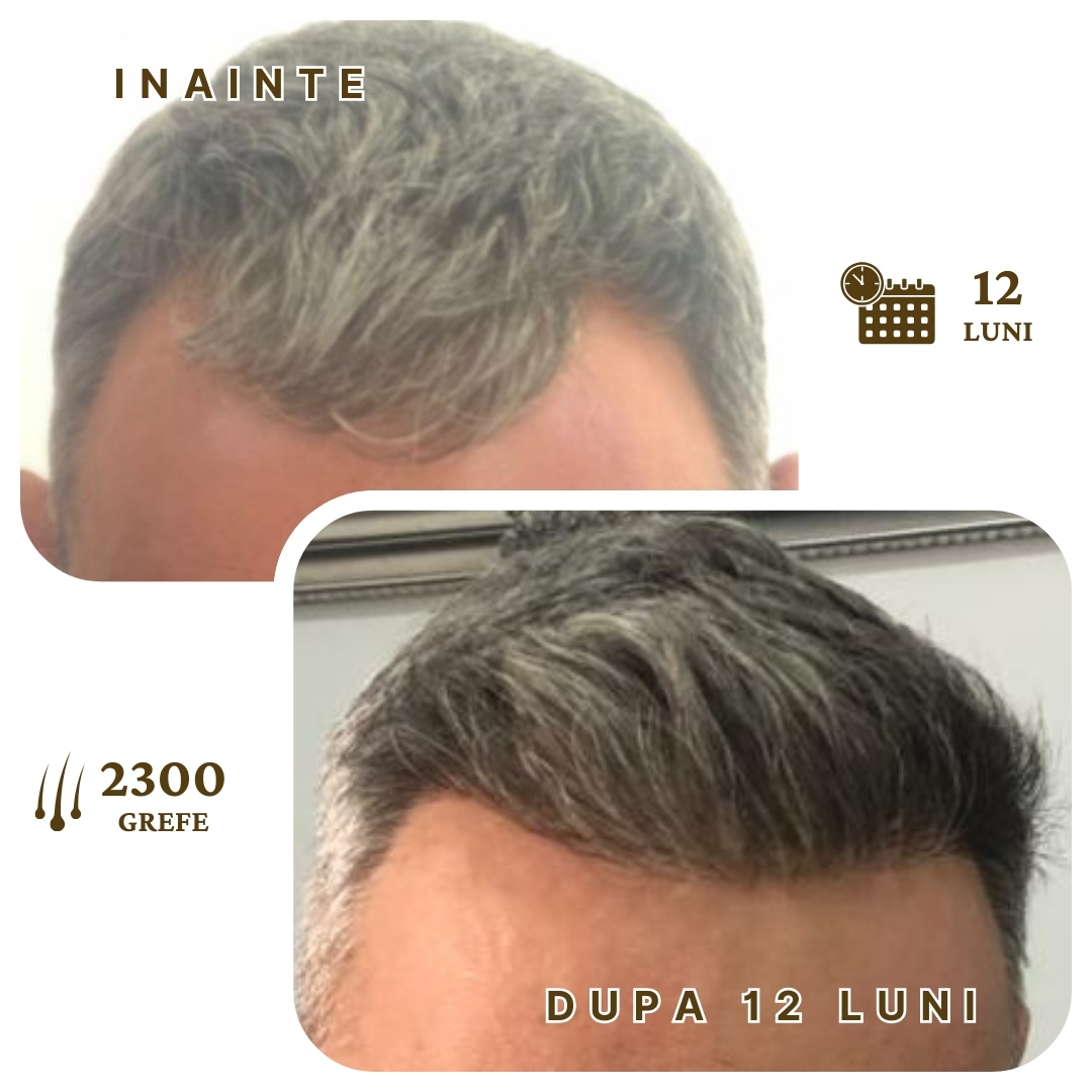 Rezultat Transplant Par