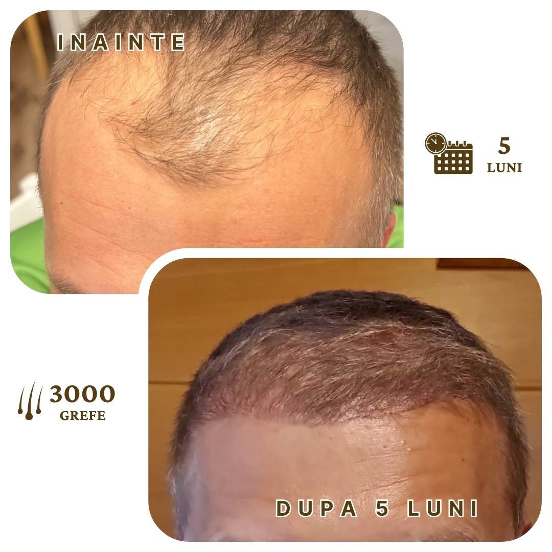 Rezultat Transplant Par