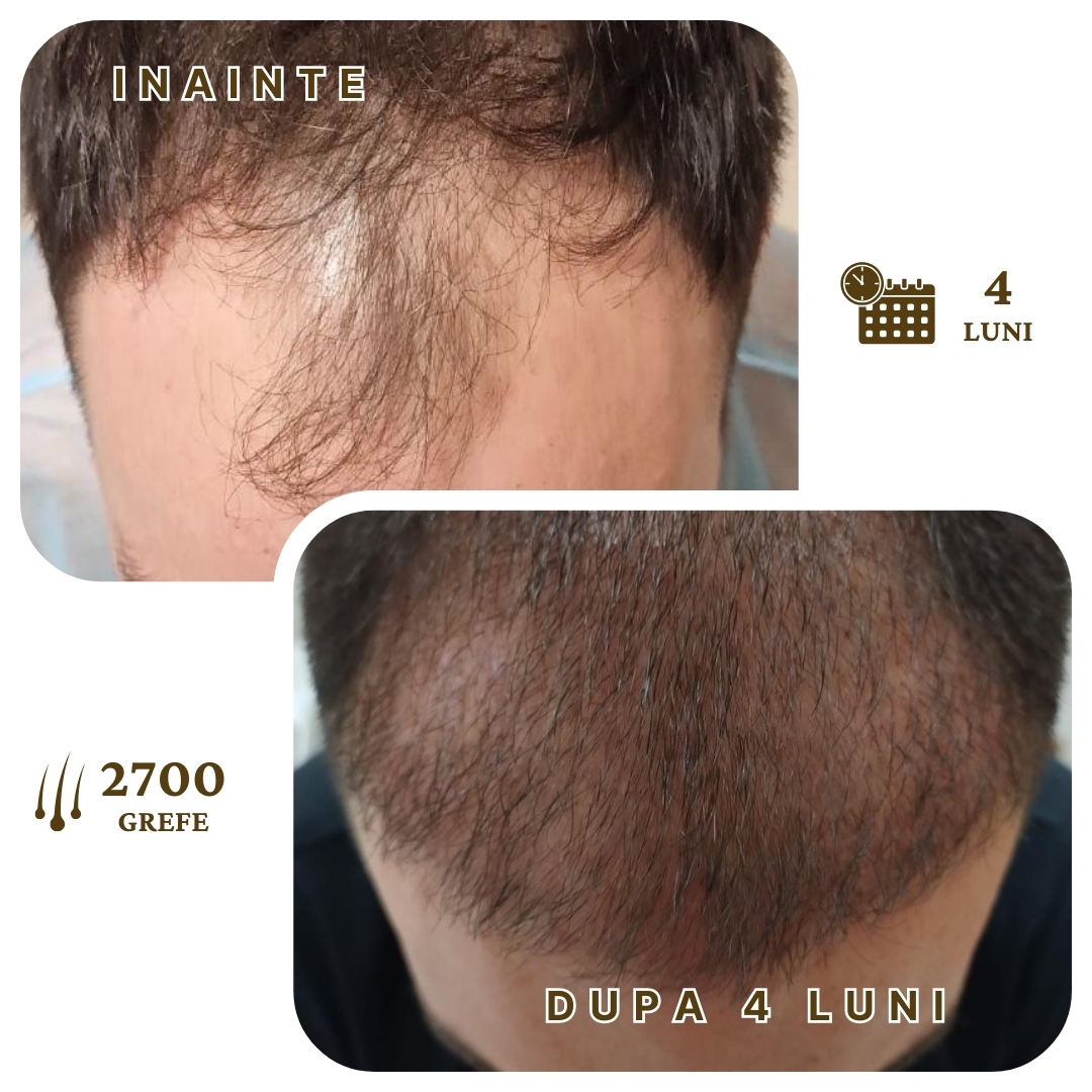 Rezultat Transplant Par