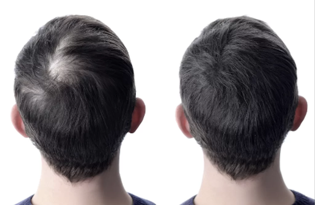 tratament exozomi păr